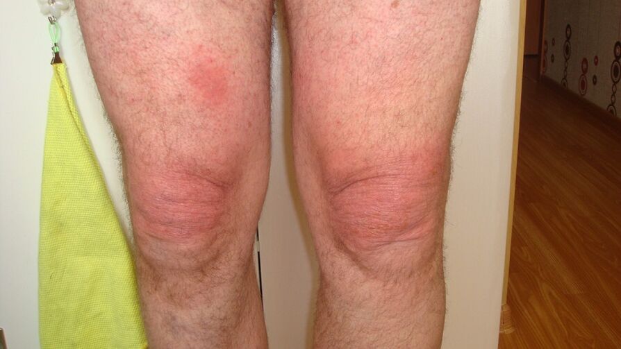 artroza zglobova koljena