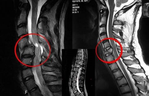 Kompresija leđne moždine - indikacija za operaciju